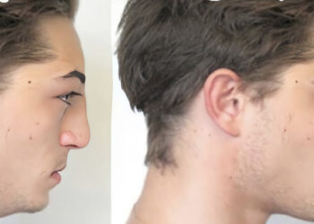 Si chiama Bone smashing, colpirsi il viso per modellare le ossa la nuova moda su TikTok