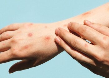 Vaiolo delle scimmie a Firenze: contagiati dopo una festa di Capodanno