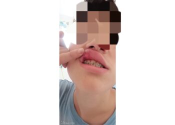 Reato di Percosse Consumato nella Galleria Umberto I di Napoli: Denuncia e Avvio delle Indagini