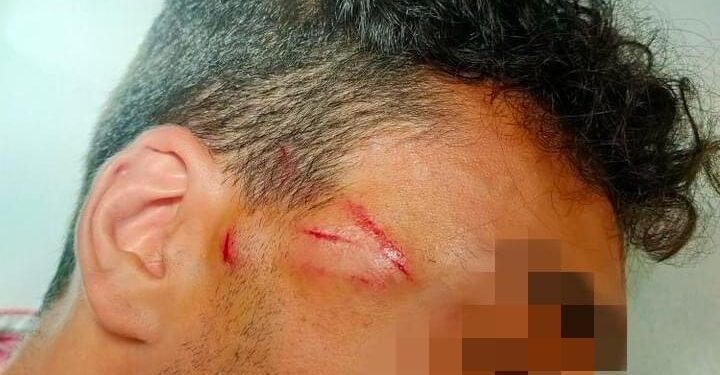 Napoli: escalation di violenza, aggredito con il calcio di una pistola