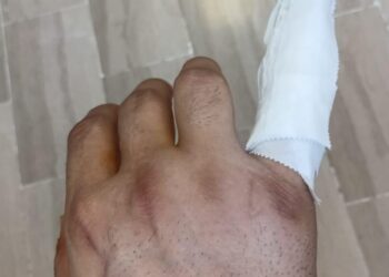 Violento pestaggio a Marechiaro. Enrico perde un dito dopo aggressione del parcheggiatore abusivo