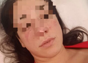 Violenta aggressione in un bar di Qualiano: una donna denuncia lesioni personali