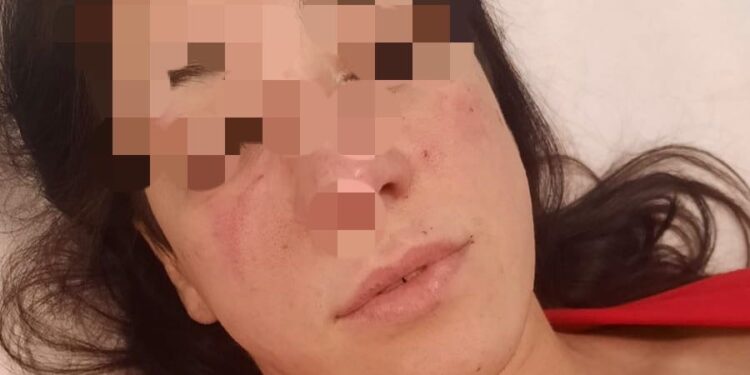 Violenta aggressione in un bar di Qualiano: una donna denuncia lesioni personali