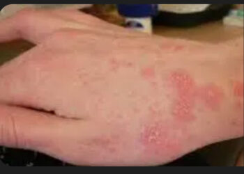 Caivano: chiusa scuola per sospetti casi di scabbia