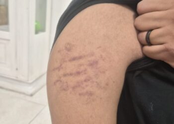 Giovane vittima di bullismo, oggi trasferito per la quarta volta dalla casa famiglia.
